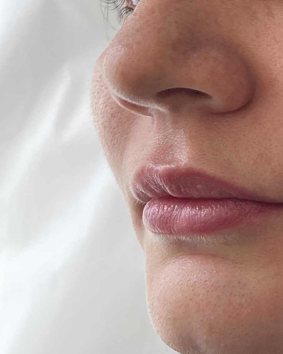 Antes y después de aumento de labios, tratado por la Dra. Lenis Núñez
